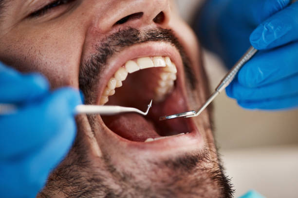 Best Dental Bonding  in Wilder, ID